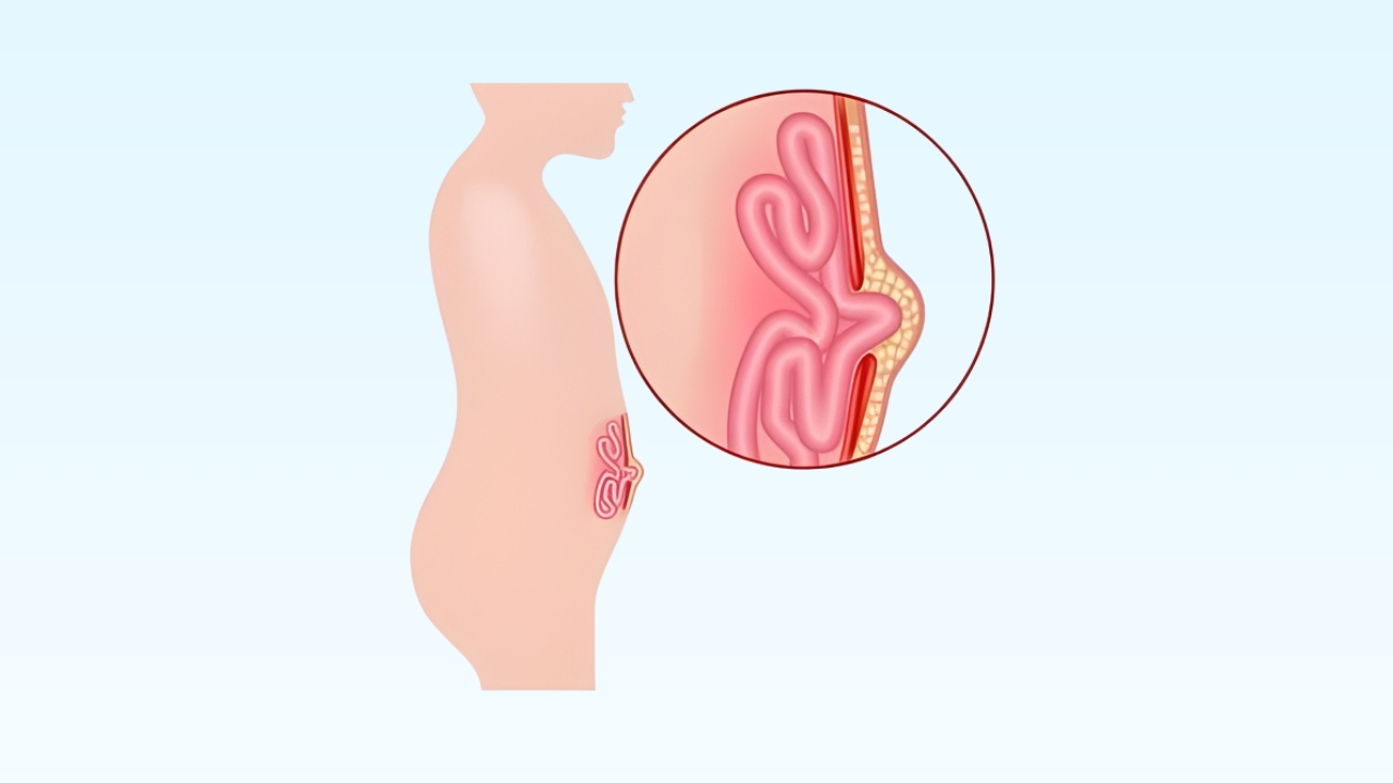 Umbilical Hernia Treatment
